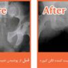 T-POD 6X Pro Trauma Pelvic Orthotic Device Pro - Image 3